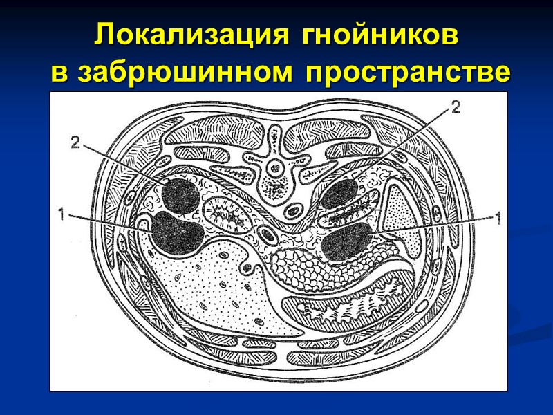 Локализация гнойников  в забрюшинном пространстве